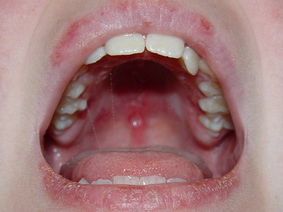 sore teeth lupus