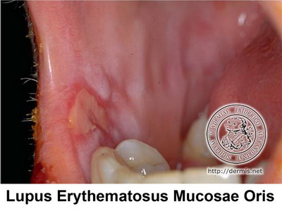 Steroid injection tongue