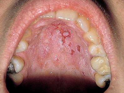 That Rash Around Your Mouth Might Be Perioral Dermatitis